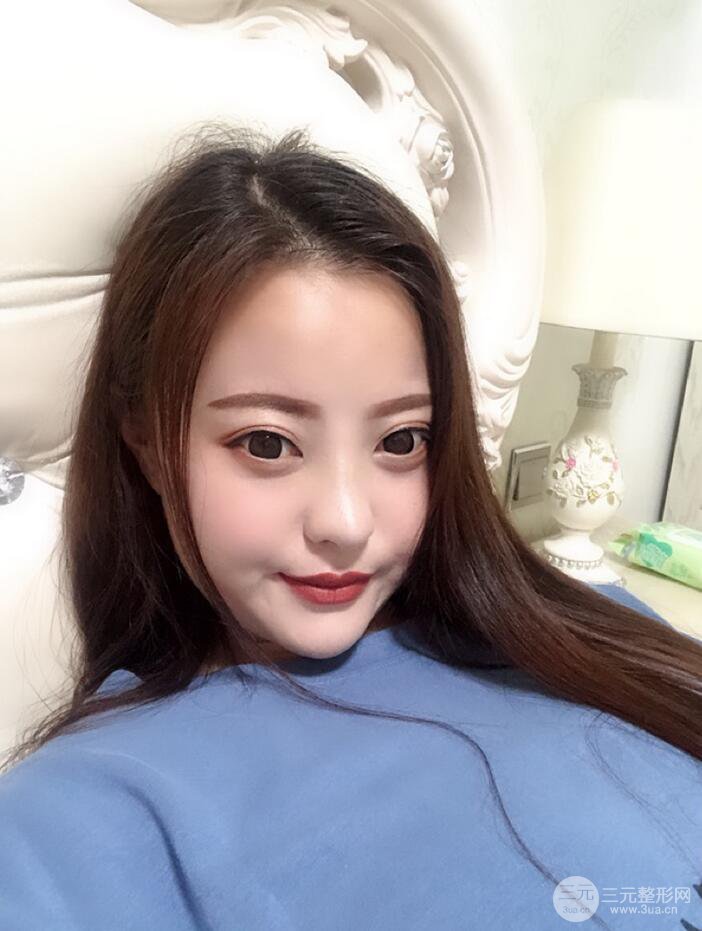 太原麗都面部吸脂+假體隆鼻案例分享，精致面部小V臉了解一下~