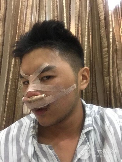成都玉之光黃開亮醫(yī)生隆鼻修復整形案例，前后恢復過程分享