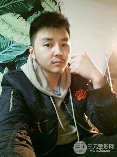 成都玉之光黃開亮醫(yī)生隆鼻修復整形案例，前后恢復過程分享