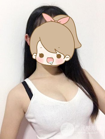 北京自體脂肪隆胸手術(shù)日記分享，豐胸術(shù)后恢復(fù)果圖