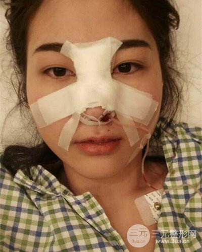 膨體隆鼻案例分享，四川華人醫(yī)療游曉波醫(yī)生做的!