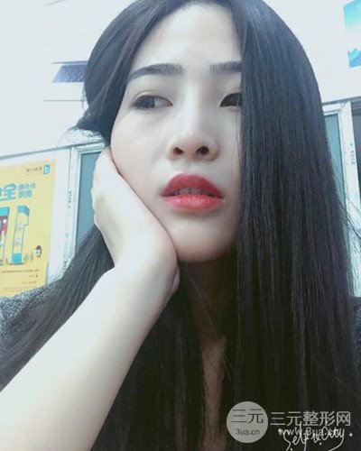 膨體隆鼻案例分享，四川華人醫(yī)療游曉波醫(yī)生做的!