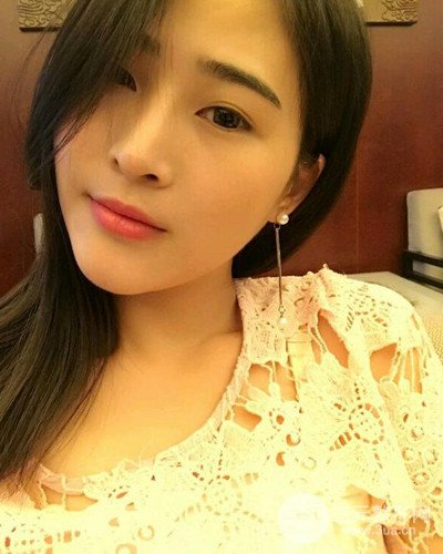 膨體隆鼻案例分享，四川華人醫(yī)療游曉波醫(yī)生做的!