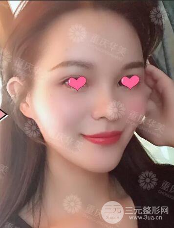 四川華美紫馨秦曉自體脂肪填充案例合集