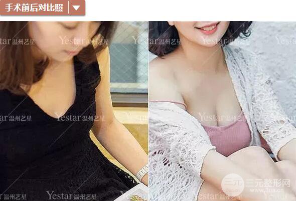溫州藝星譚立文自體脂肪隆胸案例術(shù)后恢復(fù)實記