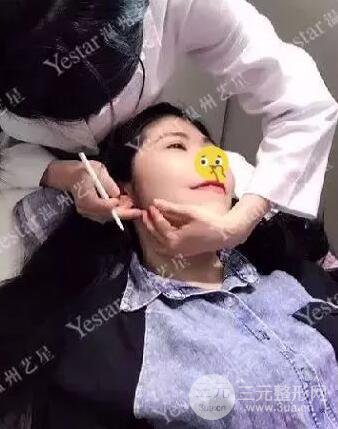 溫州藝星打B****案例術(shù)后恢復日記