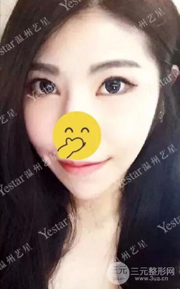 溫州藝星打B****案例術(shù)后恢復日記