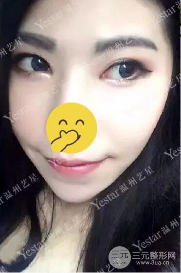 溫州藝星打B****案例術(shù)后恢復日記