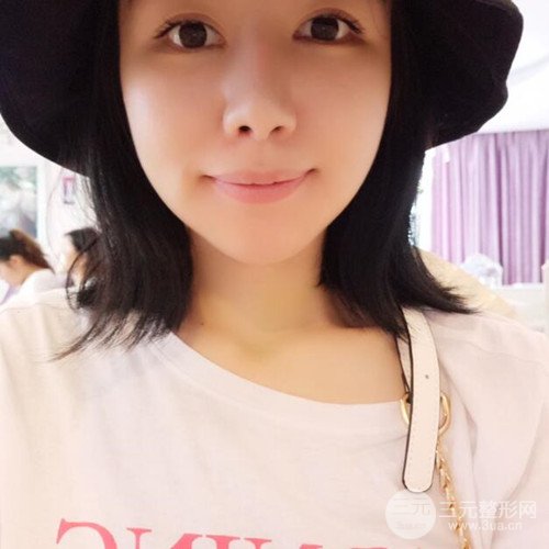 成都下頜角切除手術(shù)案例，真實(shí)果分享~