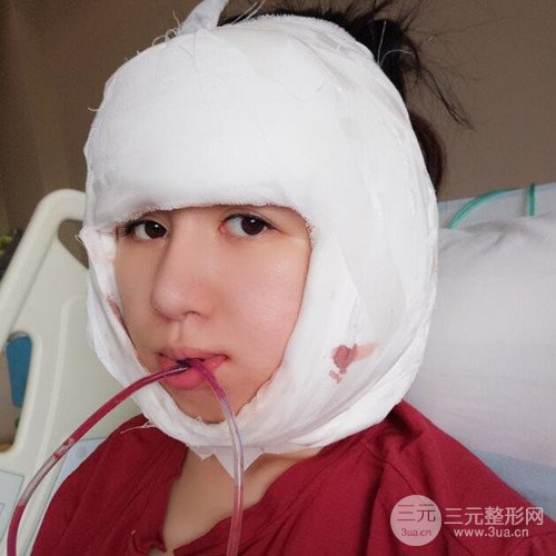 成都下頜角切除手術(shù)案例，真實(shí)果分享~