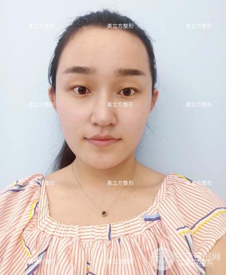 西安美立方李蓉華割雙眼皮案例術(shù)后恢復(fù)日記