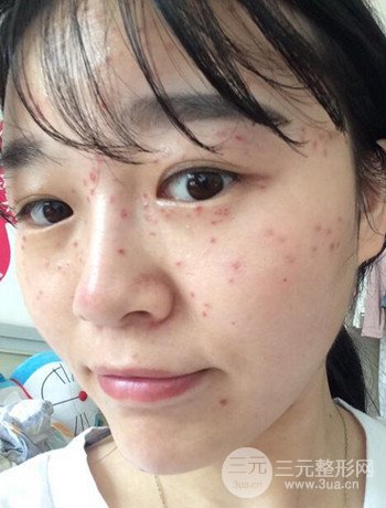 北京激光去雀斑真實案例分享，純素顏無濾鏡果圖