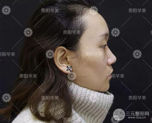 貴陽(yáng)華美整形田永華雙眼皮+隆鼻+脂肪填充術(shù)后恢復(fù)日記