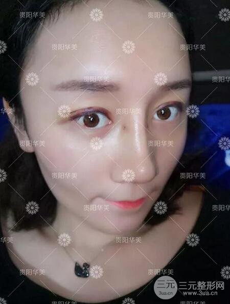 貴陽(yáng)華美整形田永華雙眼皮+隆鼻+脂肪填充術(shù)后恢復(fù)日記