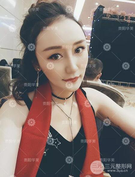 貴陽(yáng)華美整形田永華雙眼皮+隆鼻+脂肪填充術(shù)后恢復(fù)日記