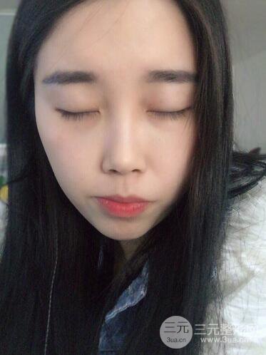 杭州藝之花楊海波整形醫(yī)生雙眼皮案例恢復(fù)日記