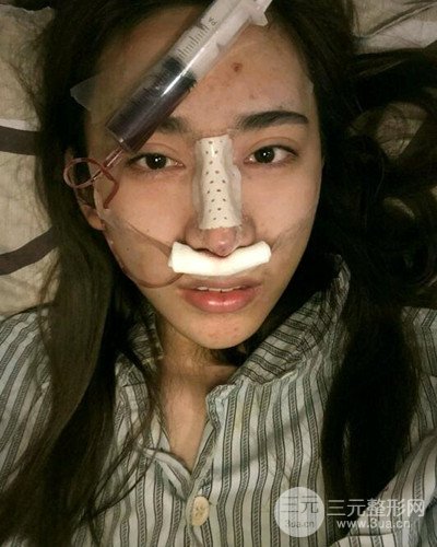 硅膠隆鼻假體取出隆鼻修復(fù)手術(shù)恢復(fù)過程分享