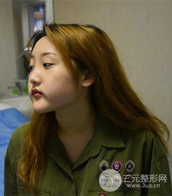 終于做了下頜角整形，分享術(shù)后恢復(fù)果