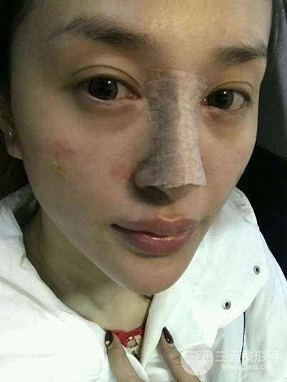 重慶鉑生王振榮隆鼻整形前后對(duì)比圖恢復(fù)過(guò)程分享