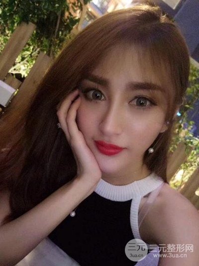 重慶鉑生王振榮隆鼻整形前后對(duì)比圖恢復(fù)過(guò)程分享