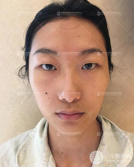 煤炭總醫(yī)院雙眼皮整形案例術(shù)后恢復(fù)一個(gè)月果