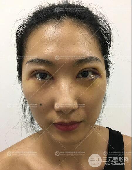 煤炭總醫(yī)院雙眼皮整形案例術(shù)后恢復(fù)一個(gè)月果