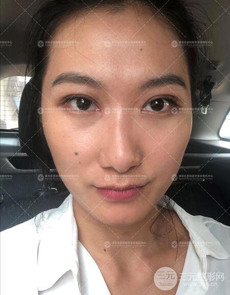 煤炭總醫(yī)院雙眼皮整形案例術(shù)后恢復(fù)一個(gè)月果