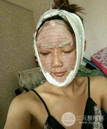 全臉自體脂肪填充手術(shù)日記分享，改良臉型年輕十歲