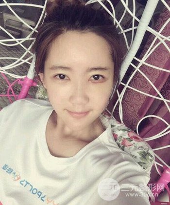 全臉自體脂肪填充手術(shù)日記分享，改良臉型年輕十歲