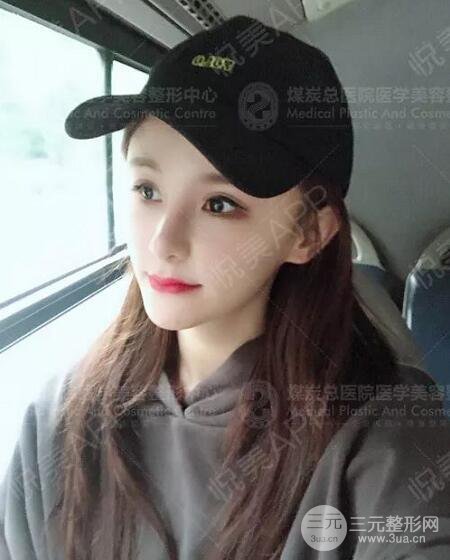 煤炭總醫(yī)院整形美容科自體脂肪填充案例