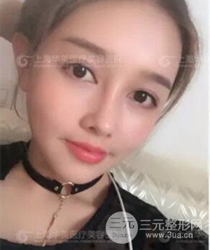 隆鼻失敗修復(fù)+詳細(xì)部自體脂肪填充案例分享，上海華美做的!