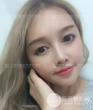 隆鼻失敗修復(fù)+詳細(xì)部自體脂肪填充案例分享，上海華美做的!