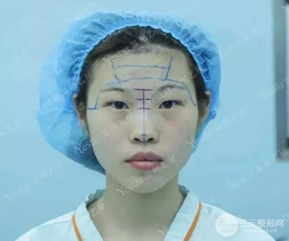 溫州藝星雙眼皮+隆鼻+自體脂肪填充案例果圖片