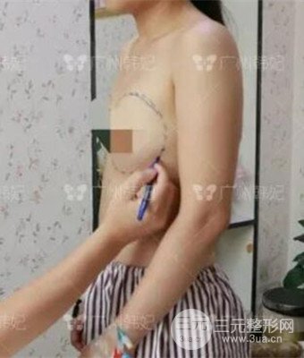 廣州韓妃劉志剛自體脂肪豐胸案例前后對比圖分享~