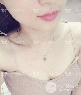 廣州韓妃劉志剛自體脂肪豐胸案例前后對比圖分享~