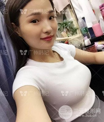 廣州韓妃劉志剛自體脂肪豐胸案例前后對比圖分享~