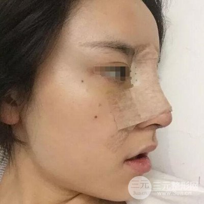 廣州艾美周琮鎮(zhèn)隆鼻案例前后對(duì)比圖分享~