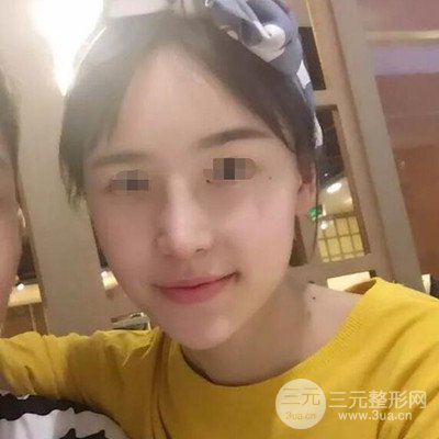 廣州艾美周琮鎮(zhèn)隆鼻案例前后對(duì)比圖分享~