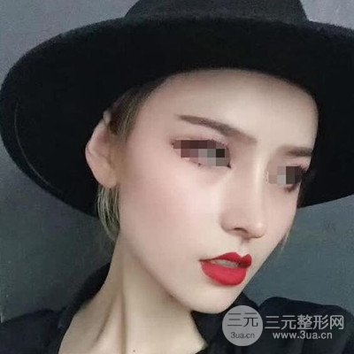 廣州艾美周琮鎮(zhèn)隆鼻案例前后對(duì)比圖分享~