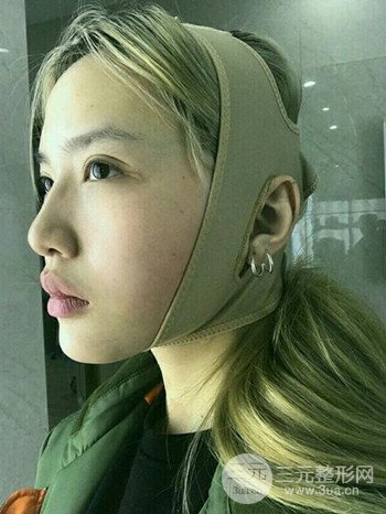 大圓臉做了面部吸脂瘦臉果很棒，立現(xiàn)漂亮鵝蛋臉