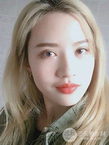 大圓臉做了面部吸脂瘦臉果很棒，立現(xiàn)漂亮鵝蛋臉