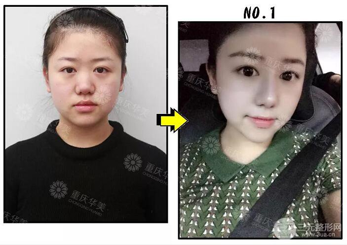 重慶華美潘寶華隆鼻案例合集一覽