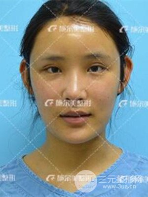 江蘇施爾美自體脂肪填充面部案例，前后對(duì)比圖分享