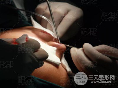 北京伊美爾徐軍假體隆鼻前后對比照片心情日記