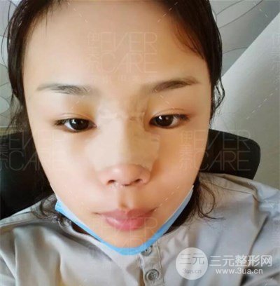 北京伊美爾徐軍假體隆鼻前后對比照片心情日記