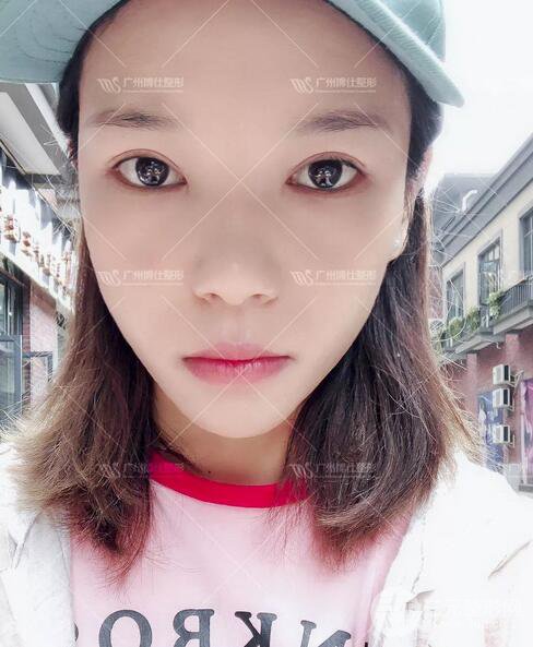 廣州博仕整形雙眼皮案例術(shù)后恢復(fù)日記