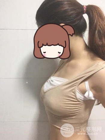 假體隆胸術后成功擺脫小學生身材，立現(xiàn)性感身材