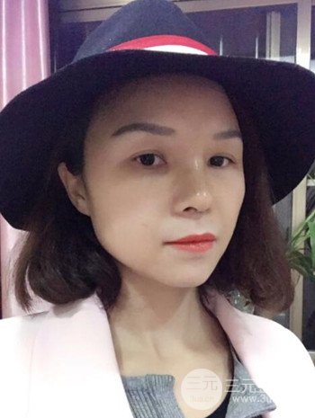 隆鼻整形手術(shù)真人案例恢復過程分享 附上果圖