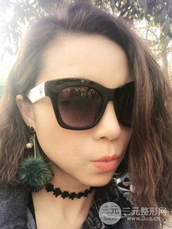 隆鼻整形手術(shù)真人案例恢復過程分享 附上果圖