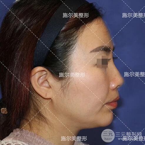 南京施爾美劉道功隆鼻案例術(shù)后恢復(fù)實(shí)記